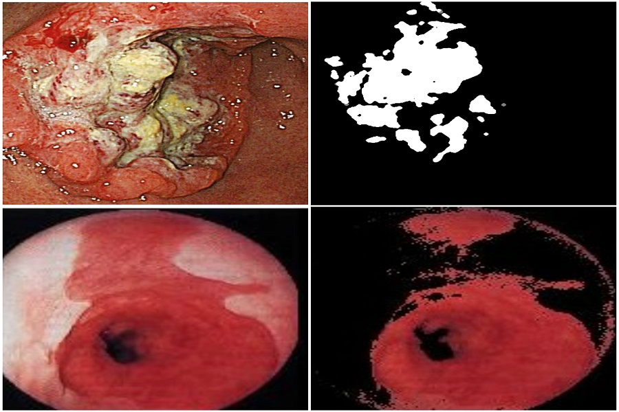 Automated Gastric Cancer Detection Using Machine Learning